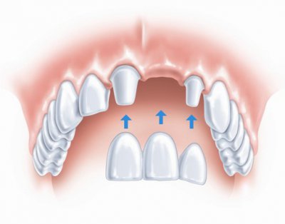 Когда проводят протезирование зубов?